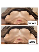 リリー(Lily)/ビフォーアフター