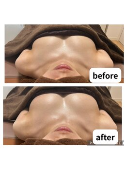 リリー(Lily)/ビフォーアフター