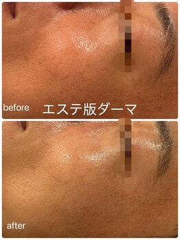 シャンス(Chance)/エステ版ダーマ 症例1回目