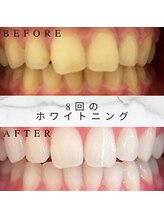 ホワイトスマイル(White Smile)/【ビフォーアフター】8回施術