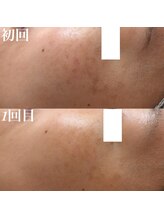 コリー(Kolly)/シミケア