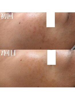 コリー(Kolly)/シミケア