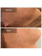 ビビ(VIVI)/男性にも人気のハーブピーリング