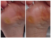 アンティ(Aunty)/足裏の胼胝