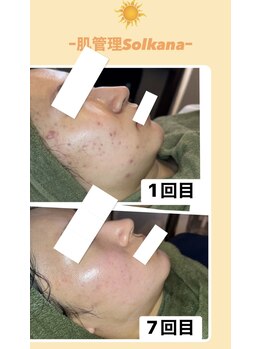 ソルカナ(Solkana)の写真/【剥離なし！ ハーブピーリング  大注目ブランドクリスティーナ使用】◆痛みの少ない施術で徹底肌改善へ◎