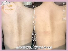 ハーバリー ハーブピーリング 大阪梅田店(HERBERRYハーブピーリング)/梅田ハーブピーリングHERBERRY