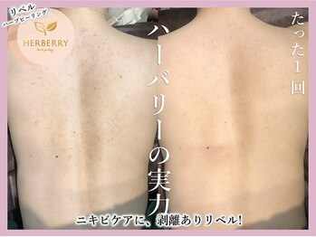 ハーバリー ハーブピーリング 大阪梅田店(HERBERRYハーブピーリング)/梅田ハーブピーリングHERBERRY