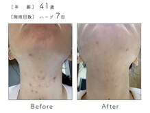 ルナスーリヤ 表参道店/ハーブピーリング