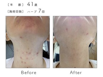 ルナスーリヤ 表参道店/ハーブピーリング