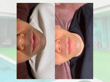 ベルゼ 渋谷店(BELZE)/男性ヒゲ脱毛♪