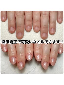 即日可愛いネイルの深爪矯正
