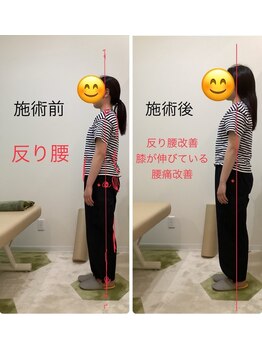 きりん接骨鍼灸院 尼崎武庫之荘店/反り腰改善♪