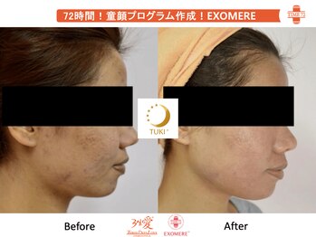 ツキ(TUKI+)/剥けない・ダウンタイム無し