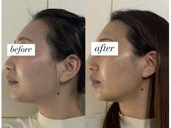 ユアン(YUAN)/美顔筋テラボーラー×美容鍼