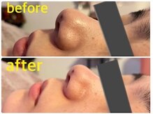 毛穴吸引・古い角質除去でお肌ツルツルに！