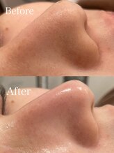 レイアス(Ray as)/毛穴洗浄で気になるざらつき改善