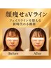 【人気NO1】顏痩せ＆Vライン形成☆劇的小顔矯正/小顔術
