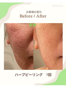 ルナスーリヤ 仙台店/ハーブピーリング