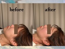 寝譜(nefu)/美容鍼BeforeAfter