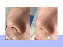 スキンラボ ドットシキブ 厚木海老名店(skinlabo .sikibu)/光フェイシャル＋毛穴洗浄コース