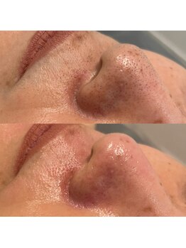 ミューズ(MUSE)/毛穴エクストラクション