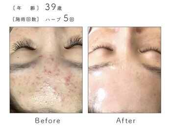 ルナスーリヤ 表参道店/ハーブピーリング