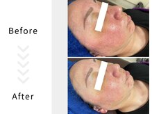 アブニールブリヨン/ハーブピーリング　Before After