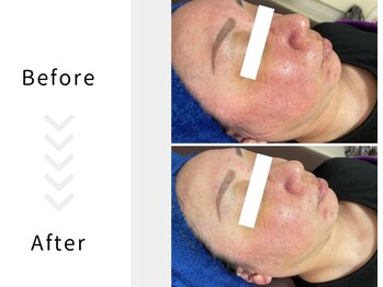 アブニールブリヨン/ハーブピーリング　Before After