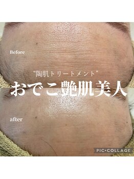 リモナ(Re-mona..)/REVIハ-ブピ-リング/おでこ美人