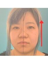 ネクスフィット(Nexfit)/小顔矯正フェイスリフトの効果