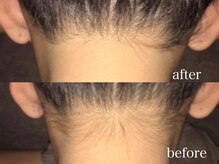 ムダ毛を減らしツルスベ肌へ導く美容ケア