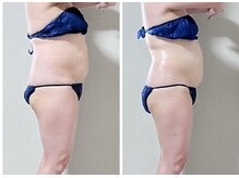 スリー(3Re)/スッキリお腹ビフォーアフター