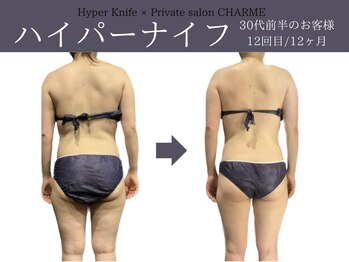 シャルム(charme)/ボコボコ撃退ハイパーナイフ痩身