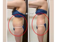 エイプリル/【痩身】比較写真