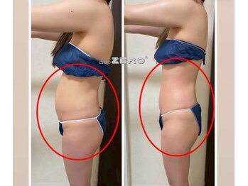 エイプリル/【痩身】比較写真