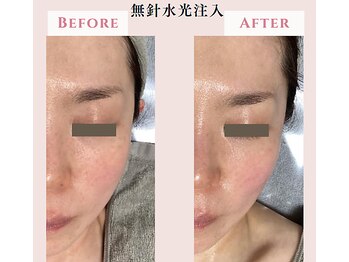 レクラ バイ ドクターエイチ(L'ECLAT by Doctor.H)/無針水光注入”美容液真皮導入”