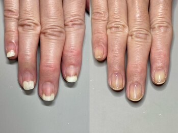ニーヨンゼロ(240)の写真/爪の形・深爪・巻き爪などのお悩みに◎プロならではの丁寧な施術で自信が持てる美しい指先に♪
