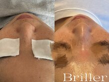 ブリエ(Briller)/毛穴洗浄＋鎮静パック
