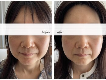 グラッソ(GRASSO)/マイクロウェーブ深層リフト