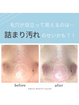エミール/毛穴エクストラクション(5)