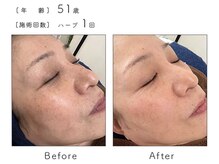 ルナスーリヤ 表参道店/ハーブピーリング