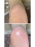  【足の爪とかかとケア】　整爪+膝下リフレ+足裏角質ケア+つぼ押し付☆　90分