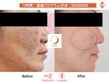 ツキ(TUKI+)/剥けない・ダウンタイム無し