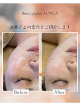 アルパカ(ALPACA)/小顔・むくみのお悩み