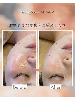 アルパカ(ALPACA)/小顔・むくみのお悩み