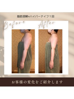 ボディケアサロン アイリフ(airef)/気になる二の腕すっきり