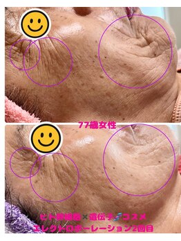 ローズ 下松(ROSE)/しわ諦めないで！