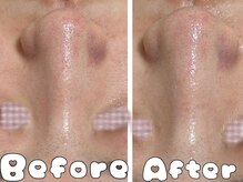 グラシア 倉敷店(Gracia)/毛穴洗浄