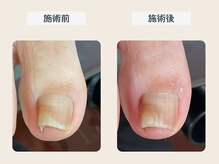 ルポ 伊勢/巻き爪ケア