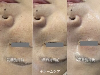 ヒュウ(hue.)/韓国発最新肌管理[セルマン]